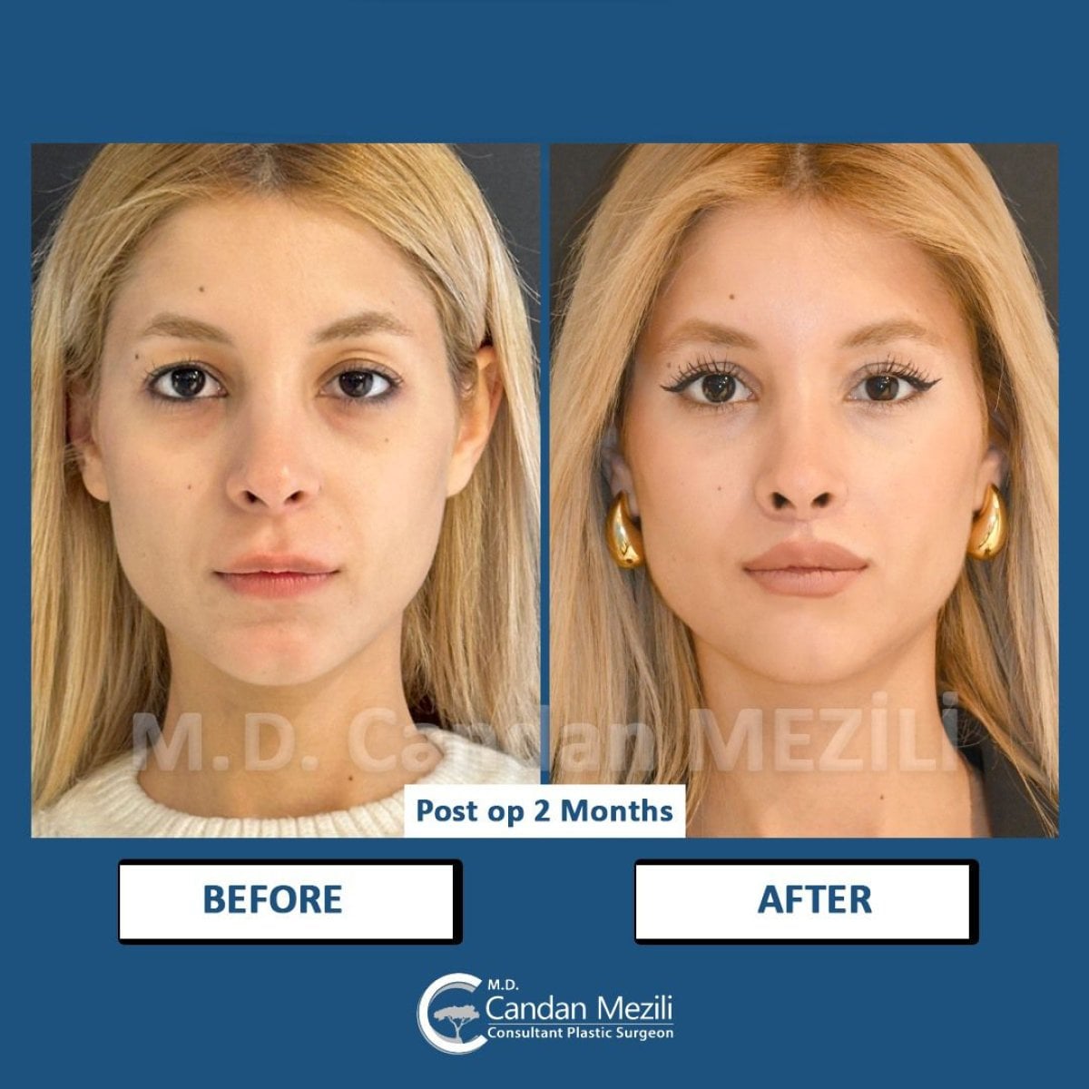 نتائج قبل وبعد Fox Eye Lift في عيادة Dr. Candan Mezili بعد شهرين من الجراحة