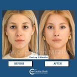 Результати до і після Fox Eye Lift у клініці Dr. Candan Mezili, 2 місяці після операції
