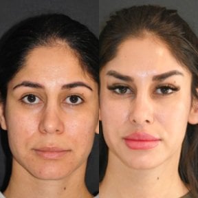 Результати до і після Fox Eye Lift у клініці Dr. Candan Mezili, ефект підтяжки повік