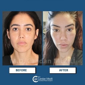 Результати до і після Fox Eye Lift у клініці Dr. Candan Mezili, піднятий контур очей