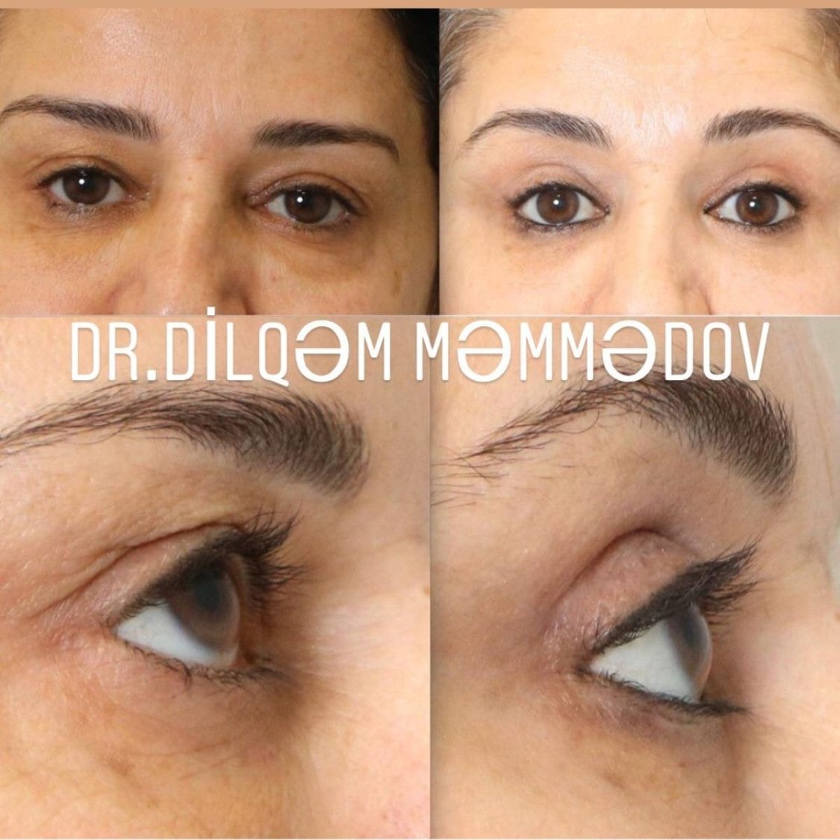 Resultados de blefaroplastia antes y después en Liv Bona Dea Hospital Baku, corrección de párpados