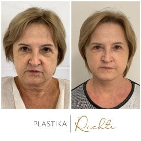 Before and after brow lift results at Altoa | Czech Hospital of Horovice, facial rejuvenation