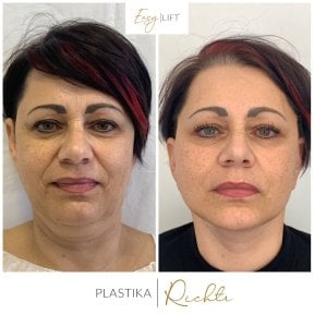 Before and after brow lift results at Altoa | Czech Hospital of Horovice, facial rejuvenation