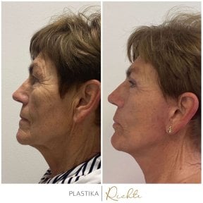Before and after brow lift results at Altoa | Czech Hospital of Horovice, visible facial rejuvenation