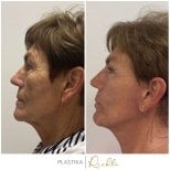 Before and after brow lift results at Altoa | Czech Hospital of Horovice, visible facial rejuvenation