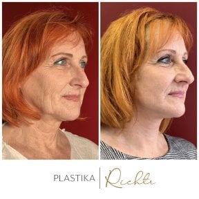 Before and after brow lift results at Altoa | Czech Hospital of Horovice, visible rejuvenation
