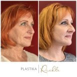 Before and after brow lift results at Altoa | Czech Hospital of Horovice, visible rejuvenation