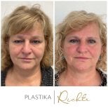 Resultados de blefaroplastia antes y después en Altoa | Hospital Checo de Horovice, corrección de párpados