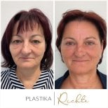 Fotos vor und nach Oberlidplastik durch Dr. 