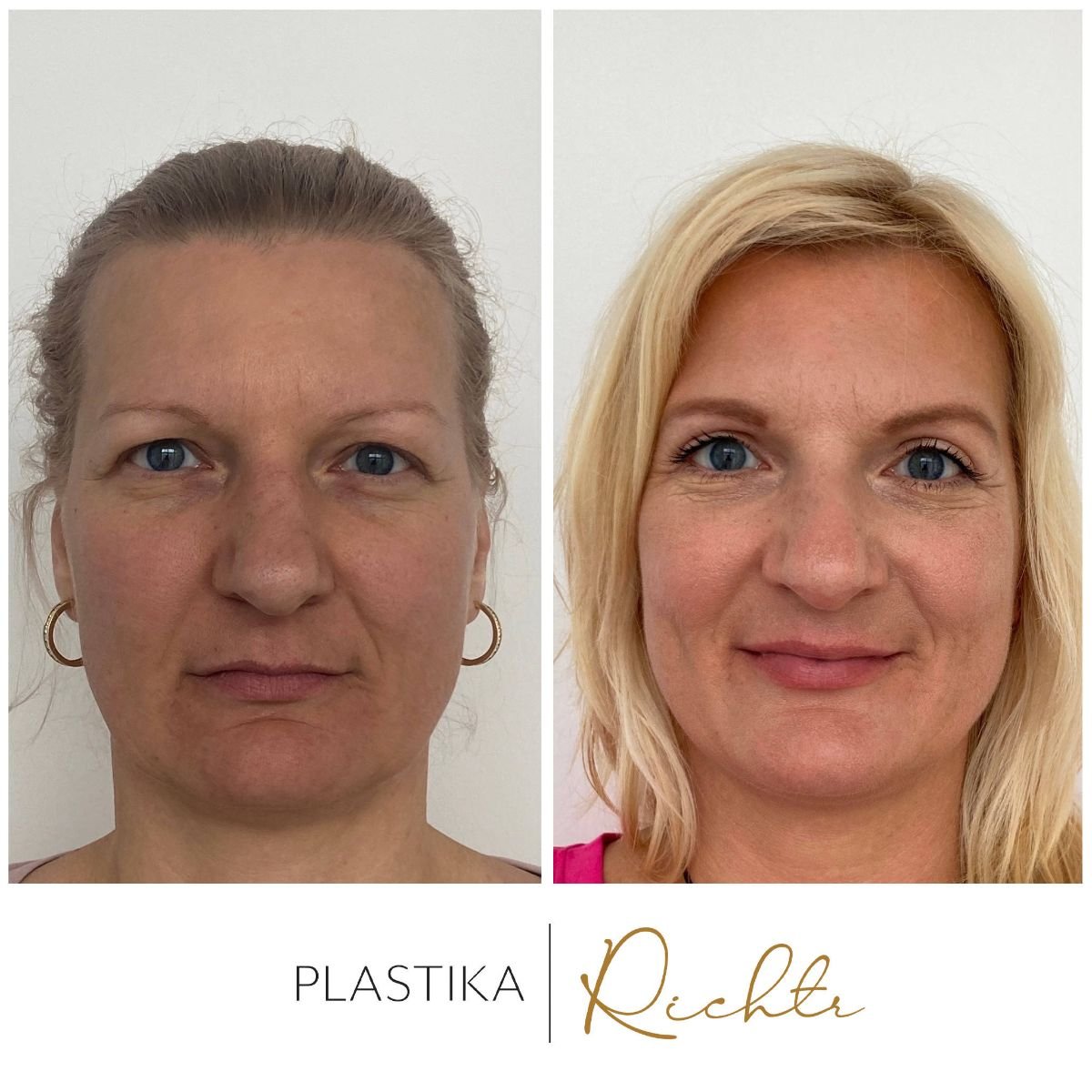 نتائج رأب الجفن قبل وبعد في Altoa | Czech Hospital of Horovice، تصحيح الجفون