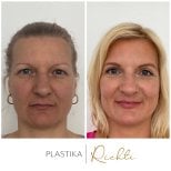 Fotos vor und nach Oberlidplastik durch Dr. 