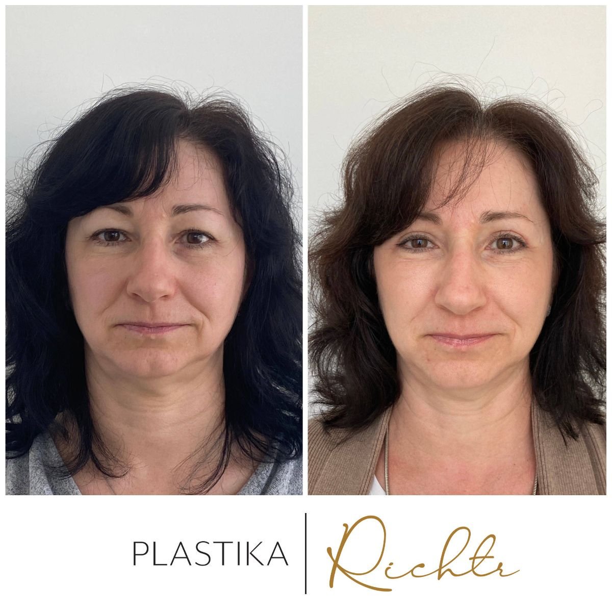 Resultados de blefaroplastia antes y después en Altoa | Czech Hospital of Horovice, corrección de párpados