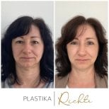 Fotos vor und nach Oberlidplastik durch Dr. 