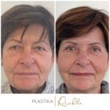 Fotos vor und nach Oberlidplastik durch Dr. 