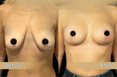 Vorher-nachher-Ergebnis Bruststraffung mit runden Implantaten bei Dr. Safa Manav Clinic