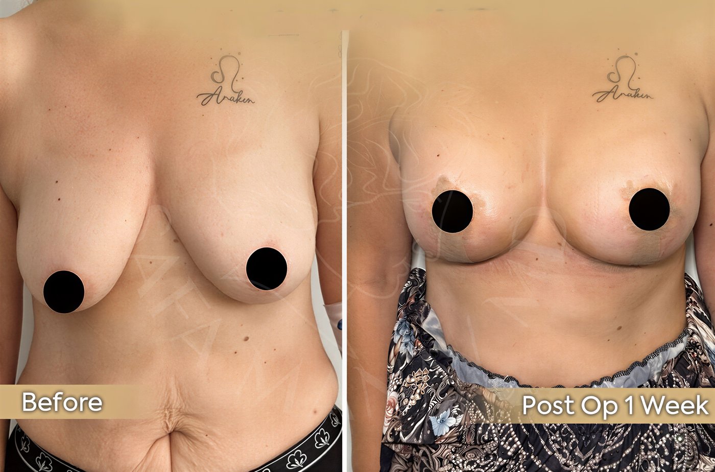 Antes y después de mastopexia con implantes redondos en Dr. Safa Manav Clinic, resultado 1 semana