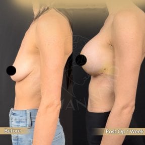 Vorher-nachher Bruststraffung mit runden Implantaten bei Dr. Safa Manav, 1 Woche Ergebnis