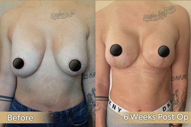 Vorher-nachher Bruststraffung mit runden Implantaten bei Dr. Safa Manav, 6 Wochen Ergebnis