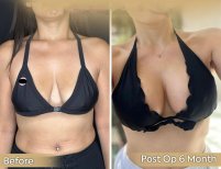Vorher-nachher Bruststraffung mit runden Implantaten bei Dr. Safa Manav, 6 Monate Ergebnis