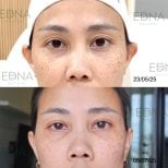 Результат до и после омоложения стволовыми клетками в EDNA Wellness, улучшение тона кожи