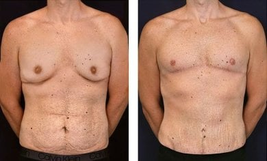 Before and after tummy tuck results for men at Dr. Alexandro Aguilera - Plastic Surgery clinic