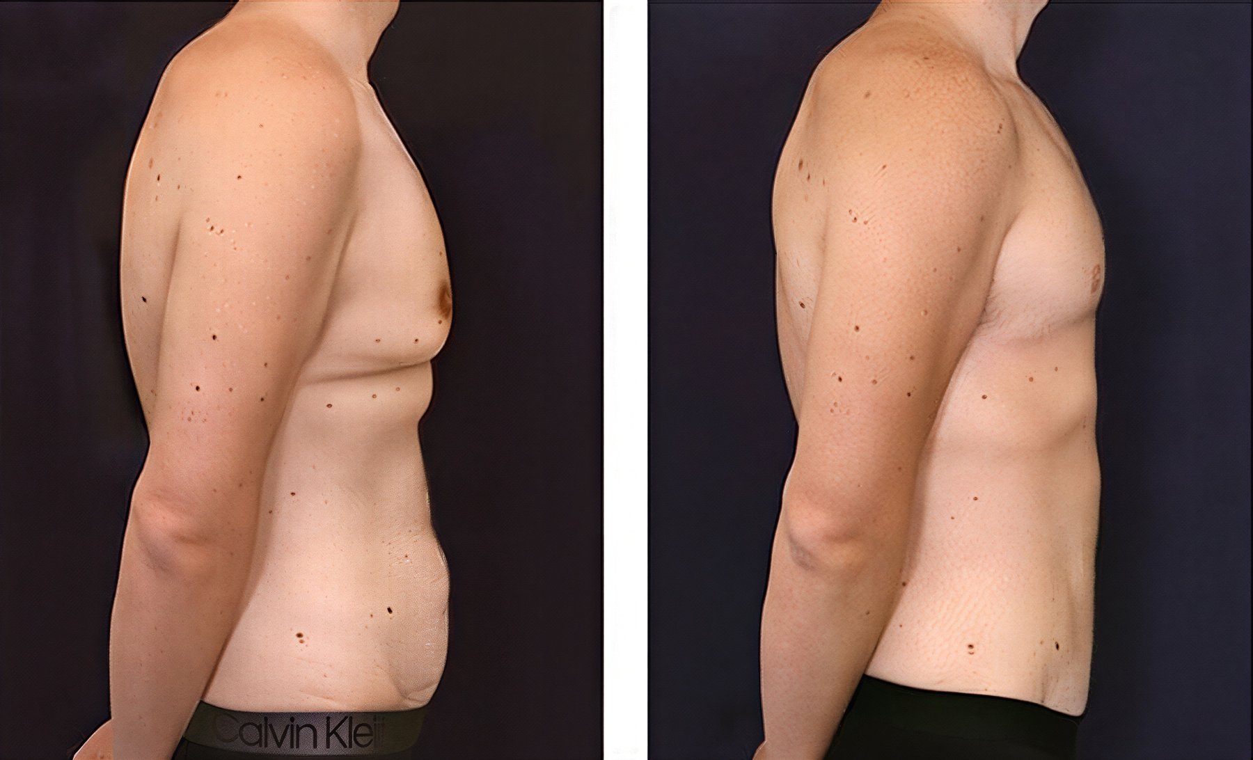 Resultados de abdominoplastia antes y después en Dr. Alexandro Aguilera - Plastic Surgery, abdomen plano
