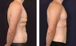 Before and after tummy tuck results at Dr. Alexandro Aguilera - Plastic Surgery, flatter abdomen