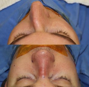 Vorher-nachher-Ergebnis der Revisionsrhinoplastik in der Private Yüzyıl Hospital, Nasenkorrektur