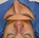 Vorher-nachher-Ergebnis der Revisionsrhinoplastik in der Private Yüzyıl Hospital, Nasenkorrektur