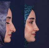 Vorher-nachher-Ergebnis der Revision-Rhinoplastik in der Private Yüzyıl Hospital, verbesserte Nasenform