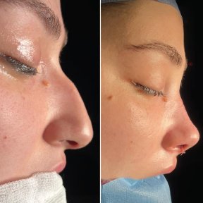 Vorher-nachher-Ergebnisse der Revisionsrhinoplastik in der Private Yüzyıl Hospital, verbesserte Nasenform