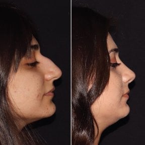 Vorher-nachher-Ergebnis der Revision-Rhinoplastik in der Private Yüzyıl Hospital, verbesserte Nasenform