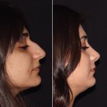 Vorher-nachher-Ergebnis der Revision-Rhinoplastik in der Private Yüzyıl Hospital, verbesserte Nasenform