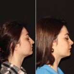 Vorher-nachher-Ergebnis der Revision-Rhinoplastik in der Private Yüzyıl Hospital, verbesserte Nasenform