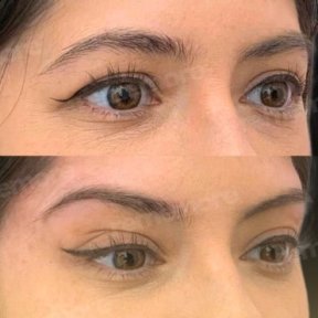 Vorher-nachher-Ergebnis Fox Eye Lift bei Memorial Göztepe Hospital, angehobener Augenkontur