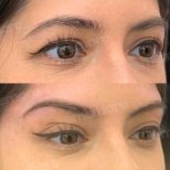 Vorher-nachher-Ergebnis Fox Eye Lift bei Memorial Göztepe Hospital, angehobener Augenkontur