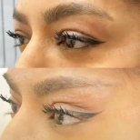Fox Eye Lift Vorher-Nachher-Ergebnisse bei Memorial Göztepe Hospital, angehobene Augenkontur