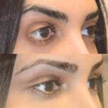 Fox Eye Lift Vorher-Nachher-Ergebnisse bei Memorial Göztepe Hospital, verbesserte Augenkontur