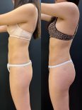Vorher-nachher-Ergebnis Brazilian Butt Lift bei Dr. Alexandro Aguilera - Plastic Surgery