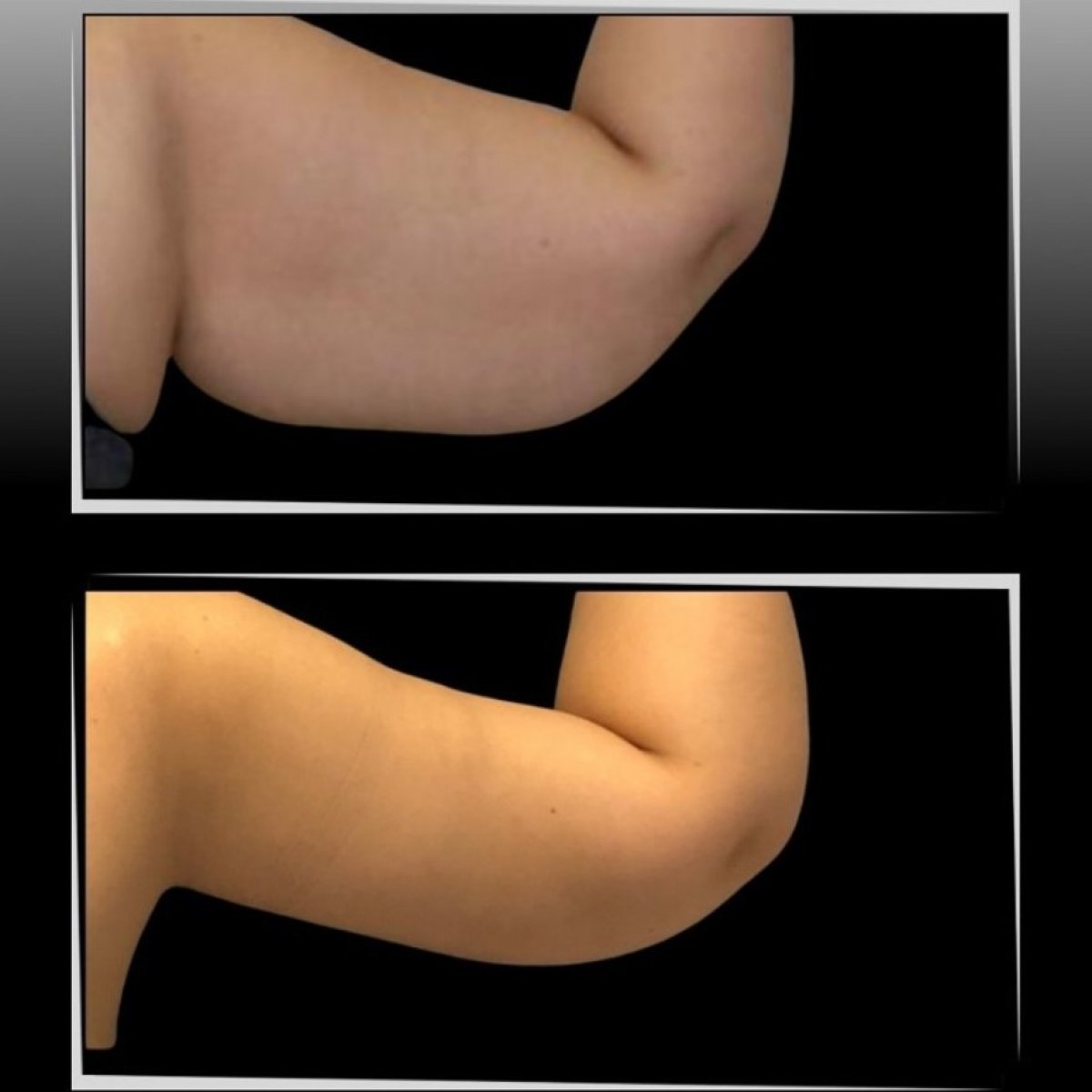 Resultados de lifting de brazos antes y después en la clínica Dr. Ilker Manavbasi, mejor contorno