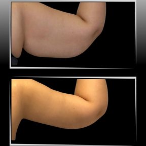 Vorher-nachher-Ergebnis Armlifting in Dr. Ilker Manavbasi's Klinik, verbesserte Kontur