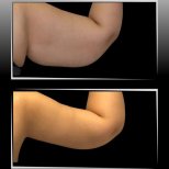 Vorher-nachher-Ergebnis Armlifting in Dr. Ilker Manavbasi's Klinik, verbesserte Kontur