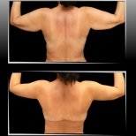 Vorher-nachher-Ergebnis der Oberarmstraffung in Dr. Ilker Manavbasis Klinik