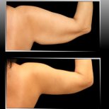 Vorher-nachher-Ergebnis Armlifting in Dr. Ilker Manavbasi's Klinik, straffere Arme