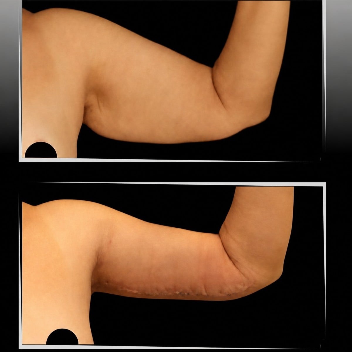 Resultados de lifting de brazos antes y después en la clínica Dr. Ilker Manavbasi, mejor contorno
