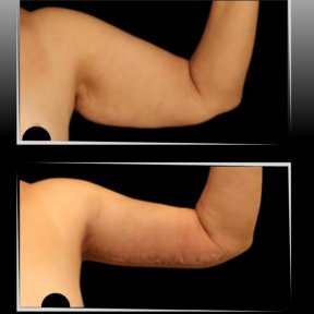 Vorher-nachher-Ergebnis einer Oberarmstraffung in Dr. Ilker Manavbasis Klinik, verbesserte Kontur