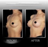 نتائج تكبير الثدي قبل وبعد في عيادة د. إلكر مانافباشي، زيادة الحجم