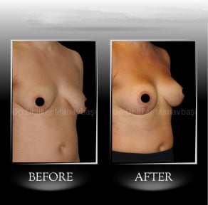 نتائج تكبير الثدي قبل وبعد في عيادة د. إيلكر مانافباشي، شكل محسن