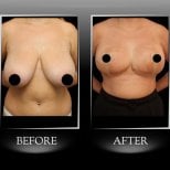Before and after breast reduction results at Dr. Ilker Manavbasi's Clinic, improved contour