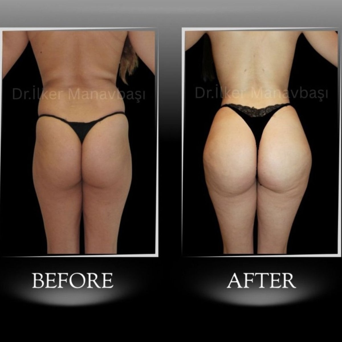 نتائج قبل وبعد عملية Brazilian Butt Lift في عيادة Dr. Ilker Manavbasi، تحسين المنحنيات